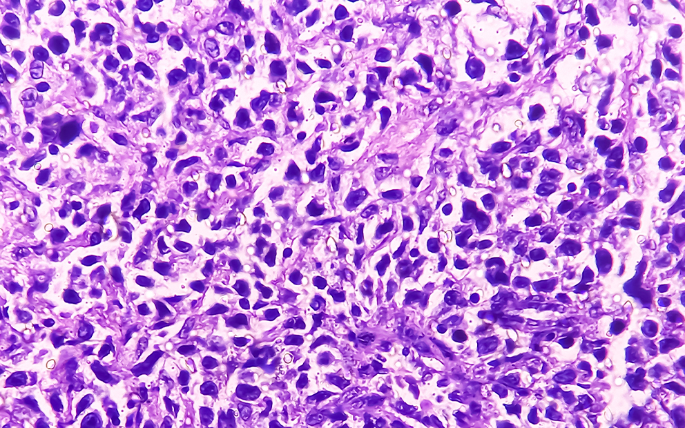 Inguinal lymph node: Non-Hodgkin's lymphoma