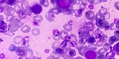 Reactive marrow with dimorphic erythroid hyperplasia