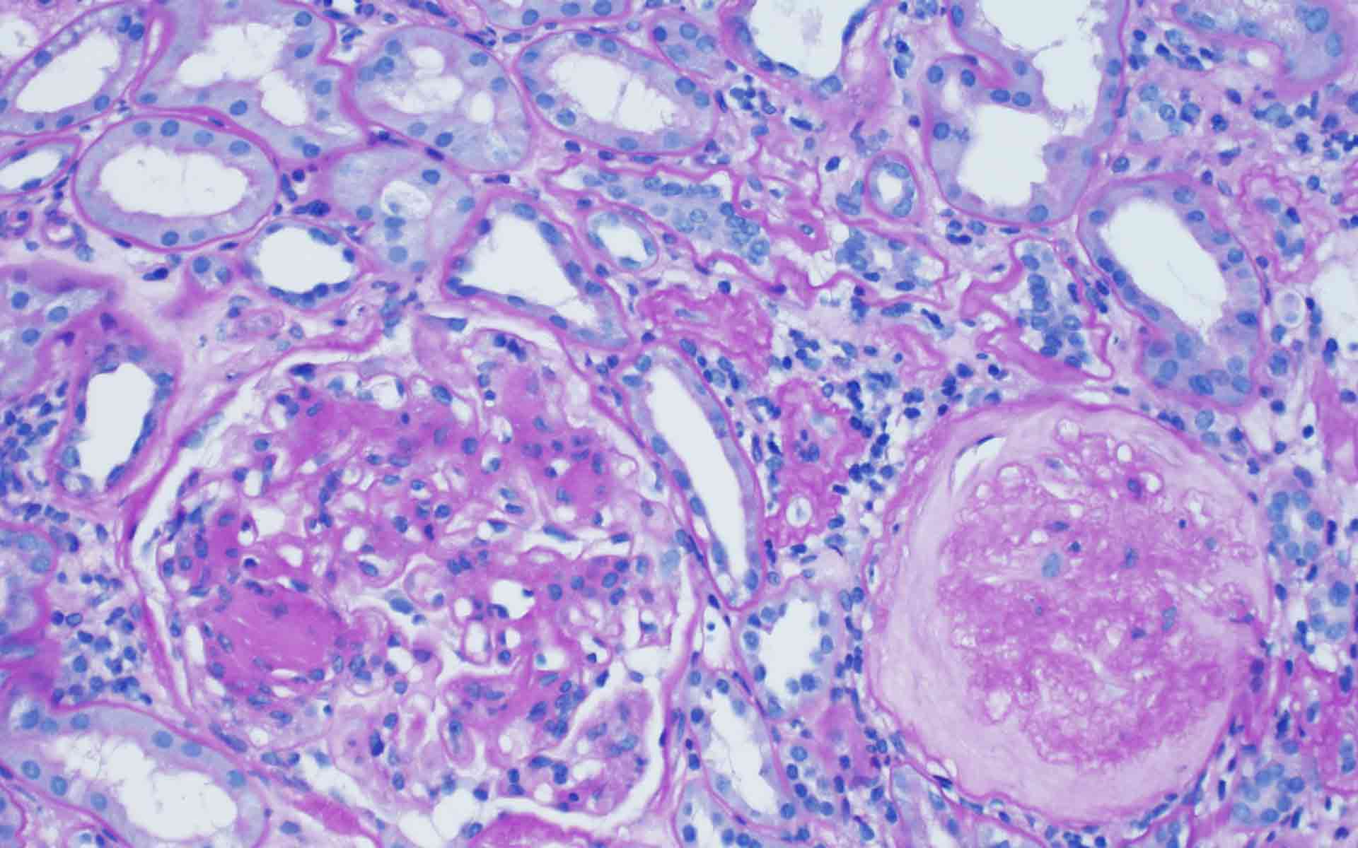 健康・医学 Diagnostic Pathology Kidney Diseases Diagnostic Pathology: Kidney Diseases: 9780443107177