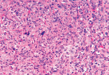 Osteosarcoma