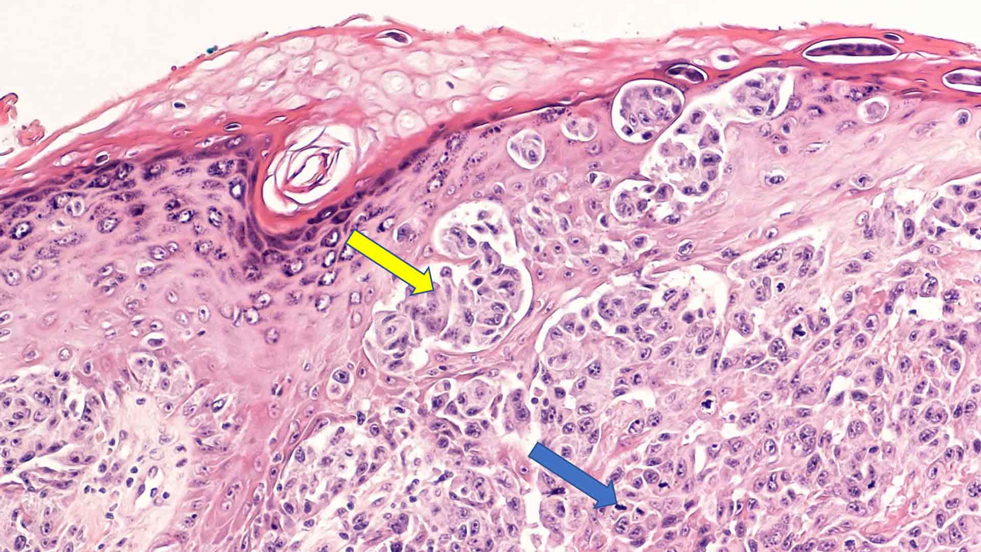 Melanoma